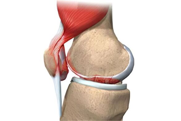 Complications of arthrosis