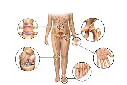 Types of arthrosis