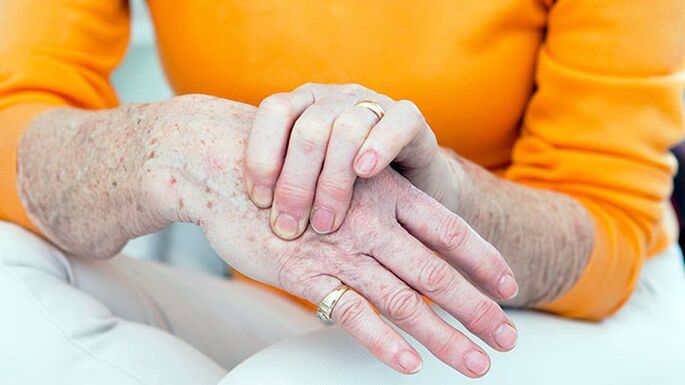 Brush arthrosis