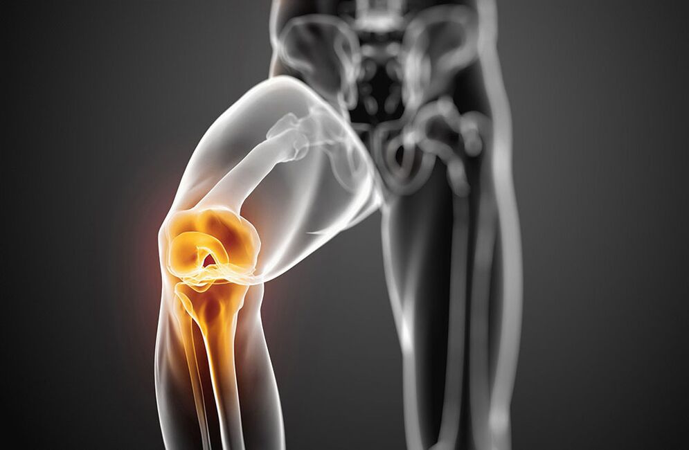 Knee arthrosis