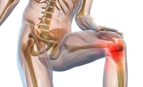 Knee arthrosis