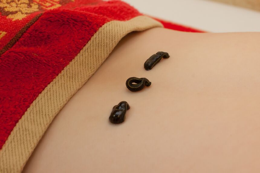 leeches on the lower back in osteochondrosis
