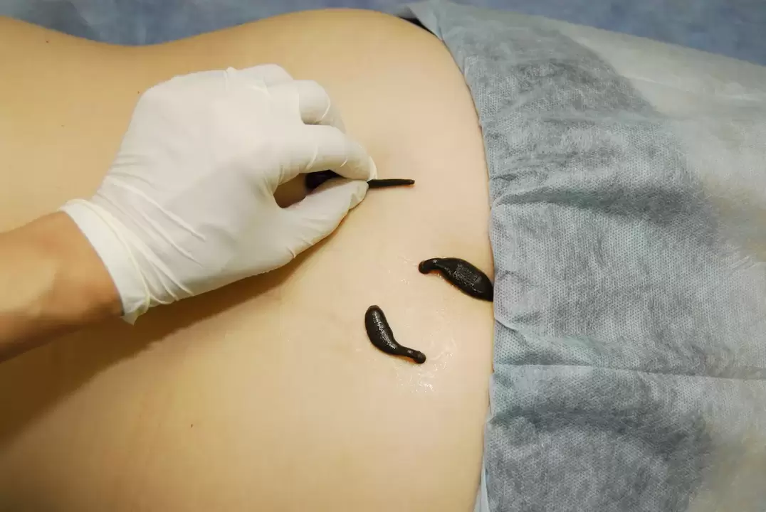 placement of leeches in lumbar osteochondrosis