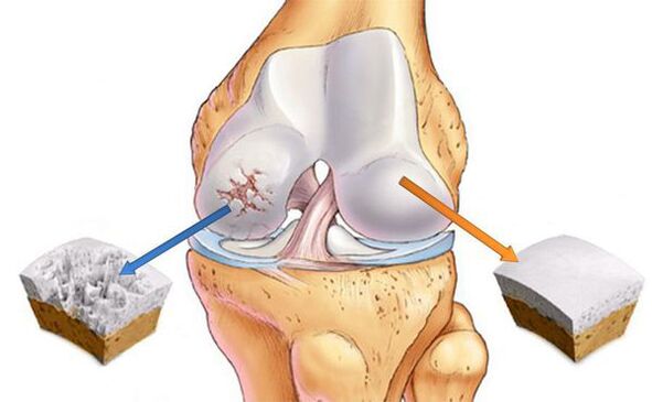 Changes in the joints in osteoarthritis (left) and normal cartilage (right)