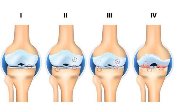 Stages of development of osteoarthritis