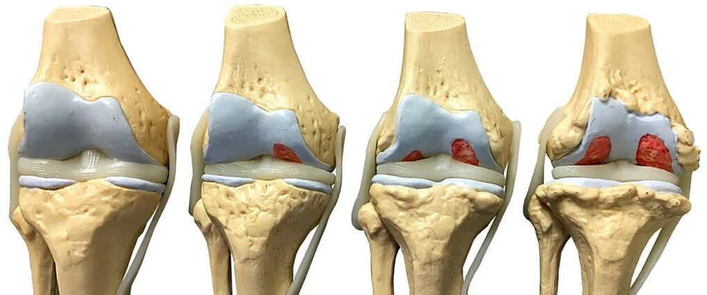 Degrees of osteoarthritis of the knee joint