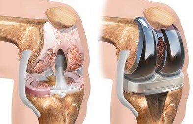 Knee endoprosthesis with gonarthrosis